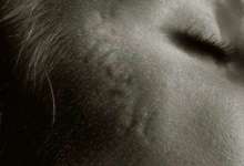 The Beauty of Scars