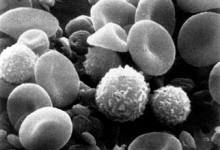 Stem Cells That Treat Leukemia, Lymphoma, HIV