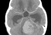 A Childhood Cancer Is Different from Adult Cancers
