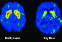 This Is Your Kid’s Brain on Drugs