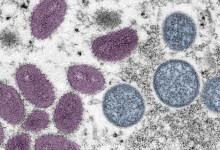 Santa Barbara County Confirms Two New Monkeypox Cases