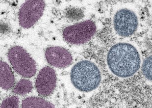 Santa Barbara County Confirms Two New Monkeypox Cases