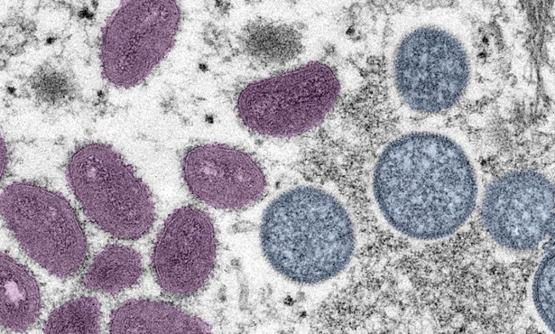 Santa Barbara County Confirms Two New Monkeypox Cases