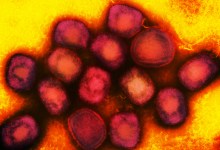 Santa Barbara Doctors Answer Questions About Monkeypox Outbreak